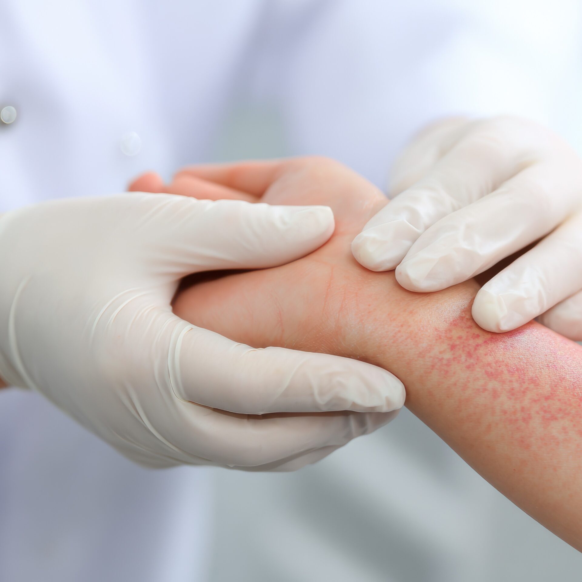 Badania kliniczne – Atopowe zapalenie skóry (AZS)