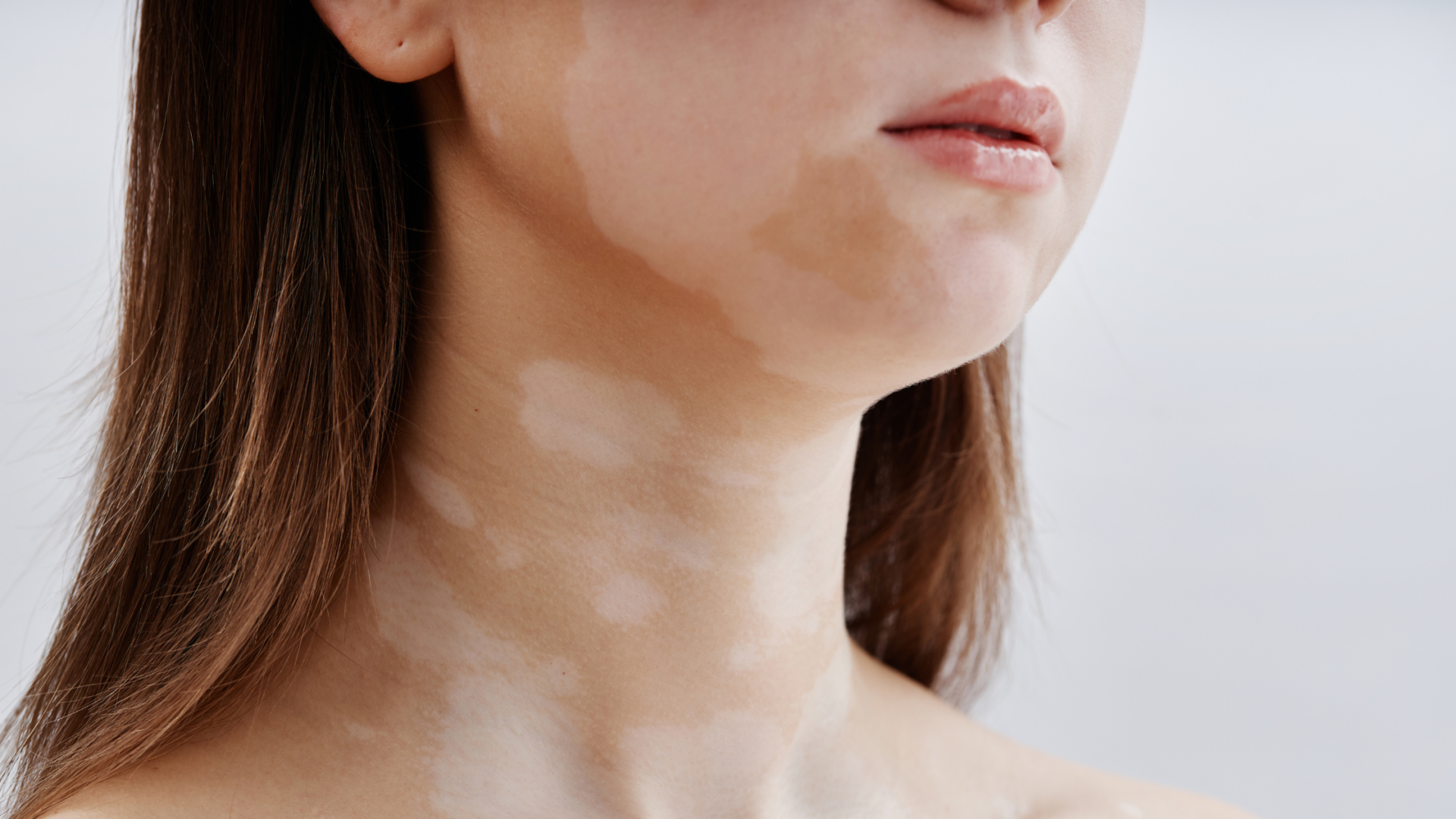 Bielactwo – co to za choroba? Przyczyny, objawy, rozpoznanie i leczenie