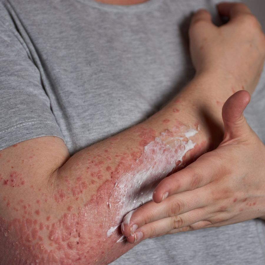 Pustular psoriasis of the hands and feet