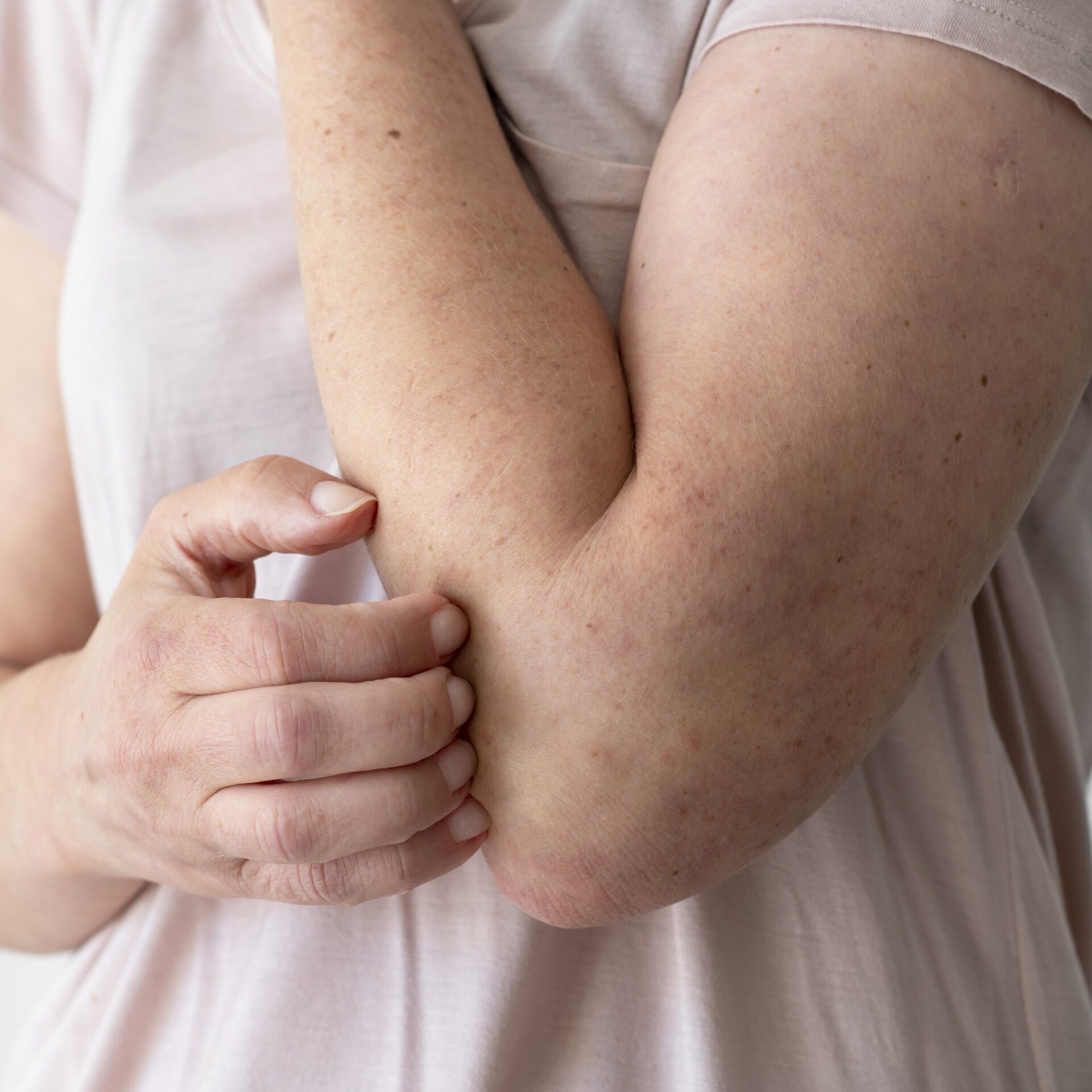 Pressure-induced urticaria (dermographism) and cold-induced urticaria